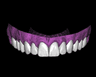 Veneers